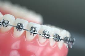 Orthodontics in Ipswich