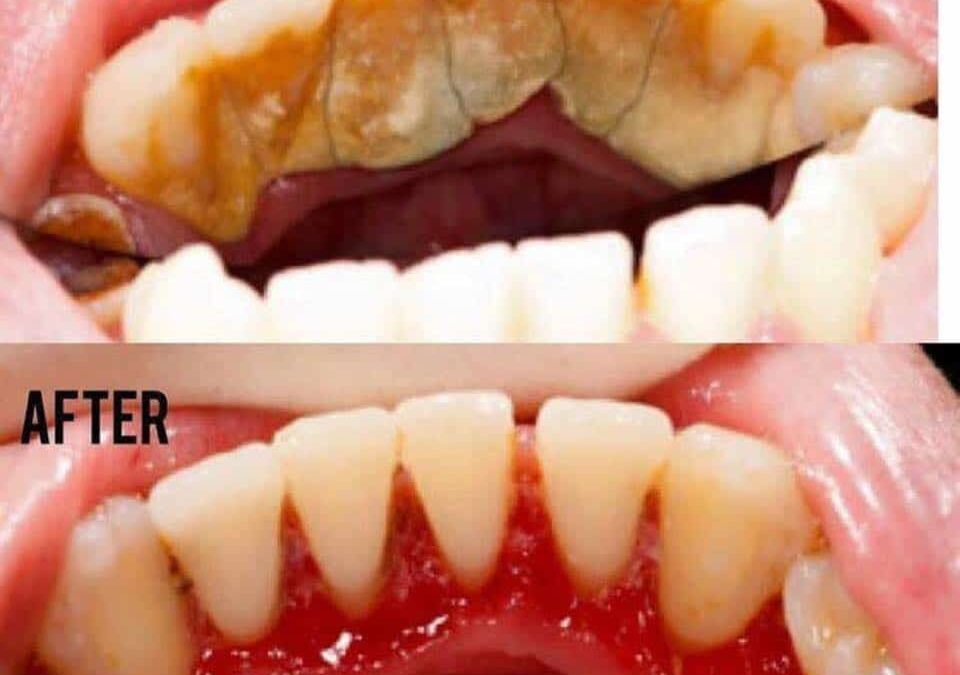 The Importance of Regular Professional Dental Cleans