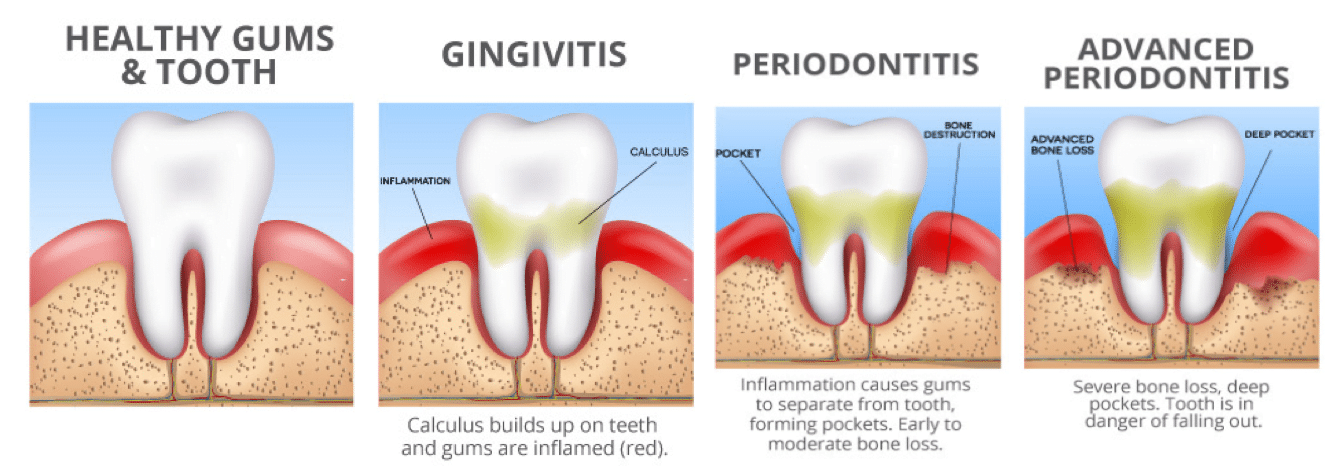 Gum Disease (Periodontal Disease) | Raceview Dental Surgery, Ipswich