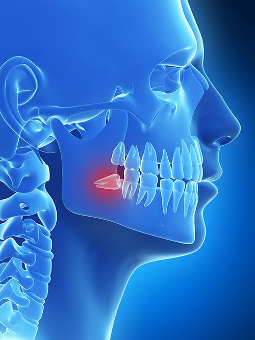 wisdom teeth removal aspendale