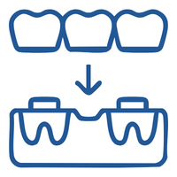 Diagram of a dental bridge: three teeth above and a two-crown bridge below supported by two abutments.